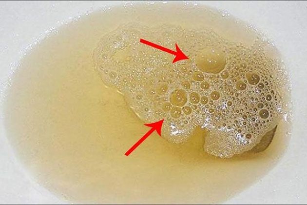 Đi ngoài ra bọt là bệnh lý gì? Có nguy hiểm không?- PQA