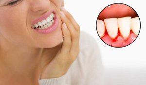 Tại sao bị chảy máu chân răng? Biểu hiện và cách khắc phục 