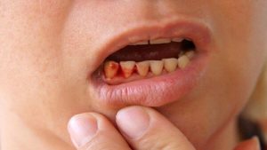 Cha mẹ nên biết: Cách chữa chảy máu chân răng ở trẻ em 