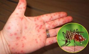 Chảy máu chân răng – Biến chứng xấu khi bị sốt xuất huyết 