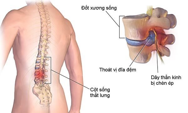 Bệnh thoái hóa đốt sống lưng – Triệu chứng và cách chữa