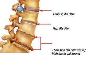 Những điều cần biết về căn bệnh thoái hóa đĩa đệm 