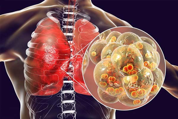 Cảnh báo biến chứng của viêm phổi tắc nghẽn mãn tính COPD