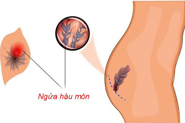 Bệnh trĩ sau sinh là gì? Cách chữa bệnh cho phụ nữ sau sinh