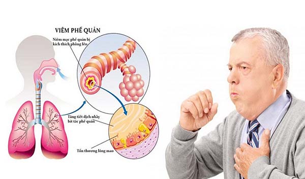 Tìm hiểu sự khác nhau giữa viêm phổi và viêm phế quản
