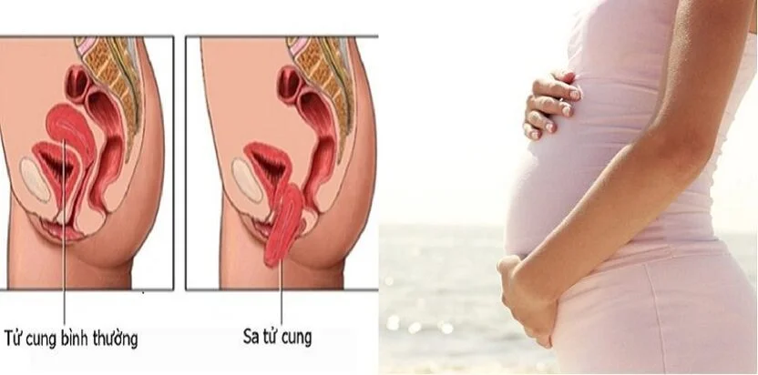sa tử cung khi mang thai