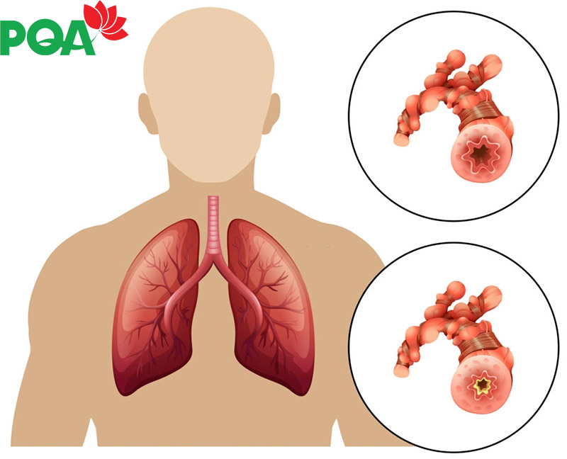 Phân biệt hen suyễn và phổi tắc nghẽn mãn tính COPD