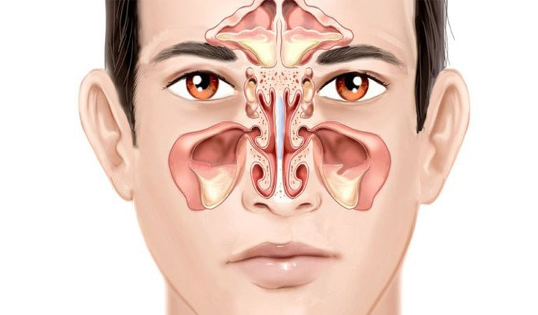 biến chứng của viêm mũi dị ứng