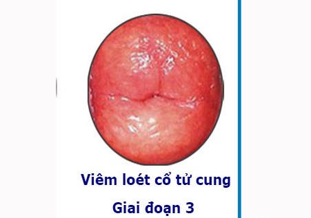 hình ảnh viêm lộ tuyến cổ tử cung độ 3