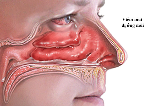 Cách chữa viêm mũi dị ứng bằng Đông y: hiệu quả từ gốc bệnh!
