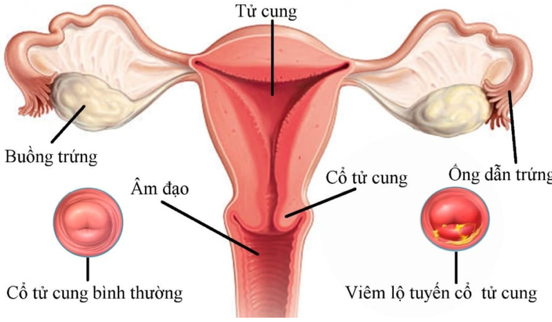 [Kiến thức] 3 cấp độ nặng nhẹ của viêm lộ tuyến cổ tử cung