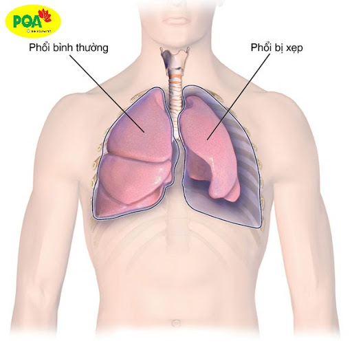 hen phế quản bội nhiễm gây ra biến chứng xẹp phổi