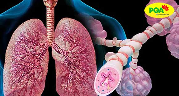 hẹp đường thở khi lên cơn hen suyễn