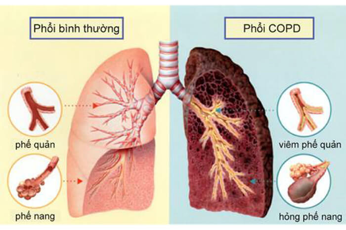 Bệnh COPD là gì? Có chữa được không? Triệu chứng và cách chẩn đoán chính xác