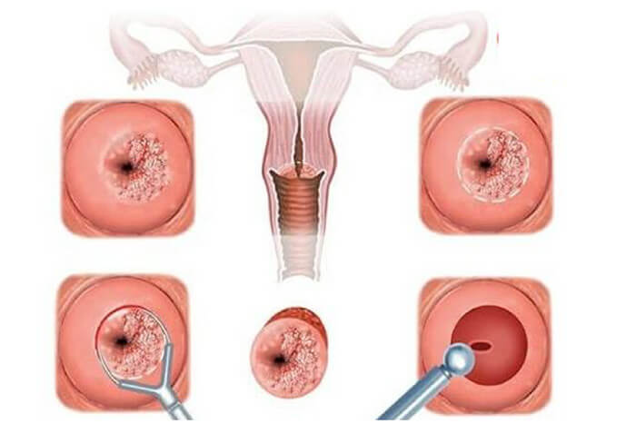 viêm cổ tử cung là bệnh gì