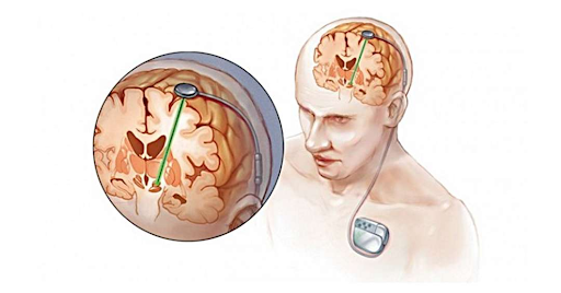 điều trị bệnh parkinson bằng phẫu thuật kích thích não sâu