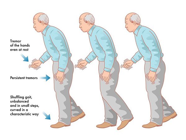 5 Giai đoạn tiến triển của bệnh Parkinson, giai đoạn cuối có chữa được không?