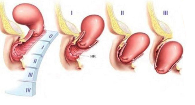 Hỏi-Đáp] Siêu âm có phát hiện sa tử cung không?