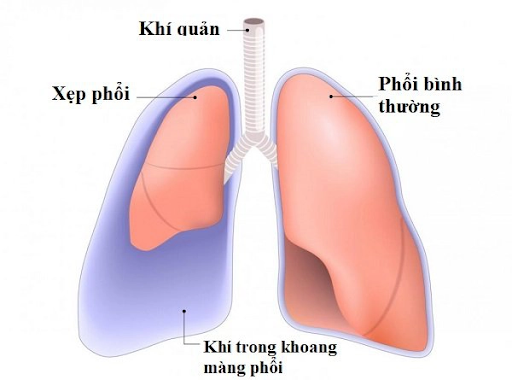 hình ảnh tràn khí màng phổi