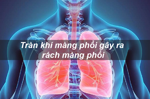 tràn khí màng phổi gây rách màng phổi