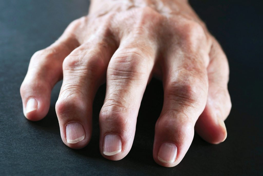 Viêm đa khớp dạng thấp gây ra tê bì chân tay