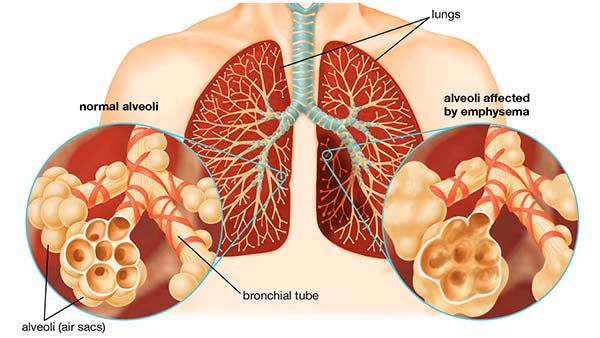 Bệnh phổi tắc nghẽn mãn tính (COPD) giai đoạn cuối nguy hiểm như nào?