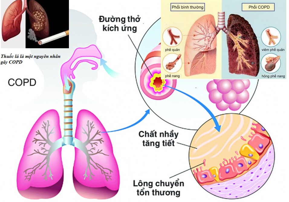 Bệnh phổi tắc nghẽn mạn tính có lây không? Giải pháp điều trị COPD