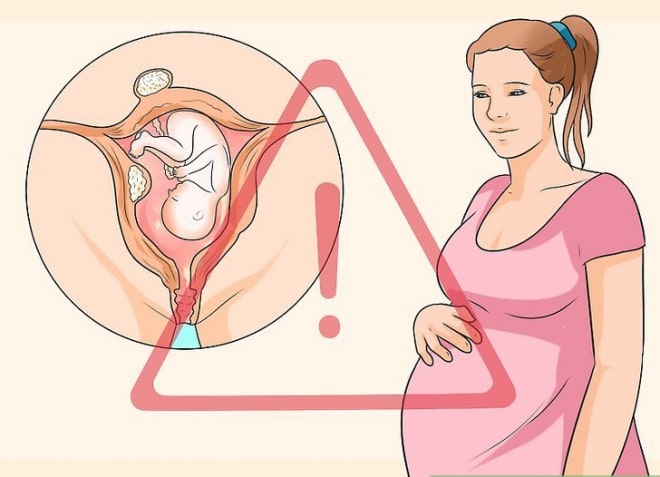 sa tử cung khi mang thai không nên sinh thường