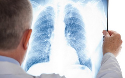 biểu hiện tràn khí màng phổi
