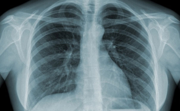 hình ảnh x quang phổi copd