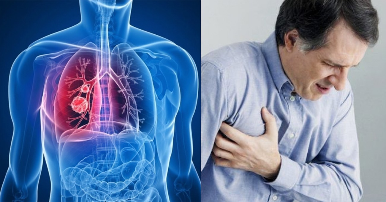dấu hiệu của ung thư phổi