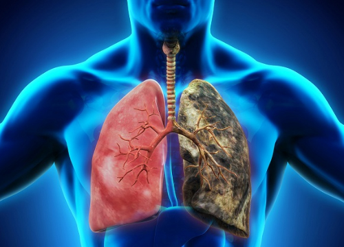 hen suyễn kéo dài tăng nguy cơ gây ung thư phổi