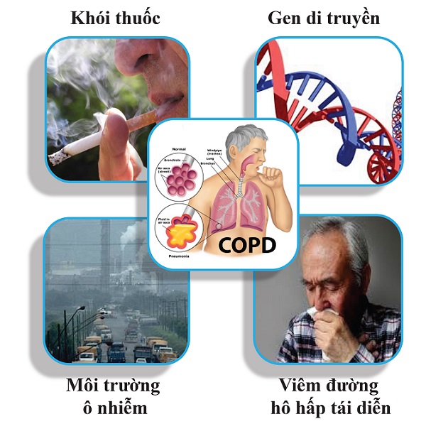 nguyên nhân bệnh COPD