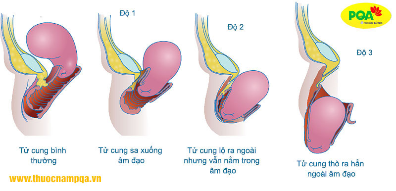 Các cấp độ của sa tử cung và hình ảnh qua từng cấp độ 1, 2, 3 – PQA