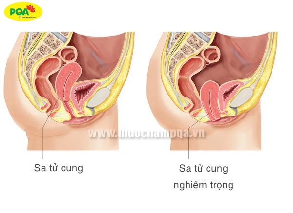 bệnh sa tử cung sau sinh