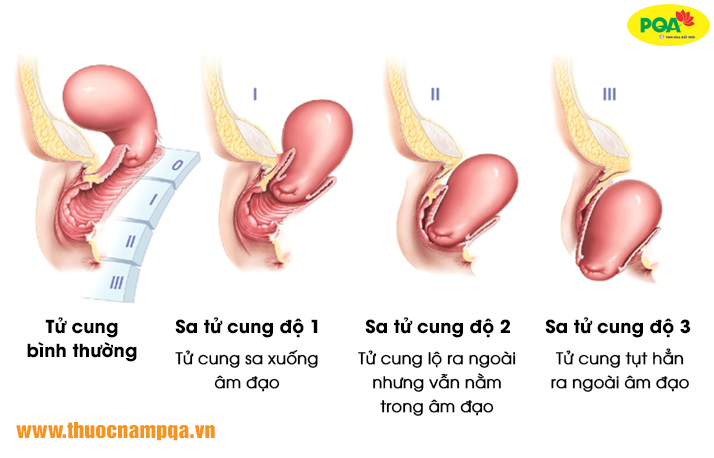 các cấp độ của bệnh sa tử cung