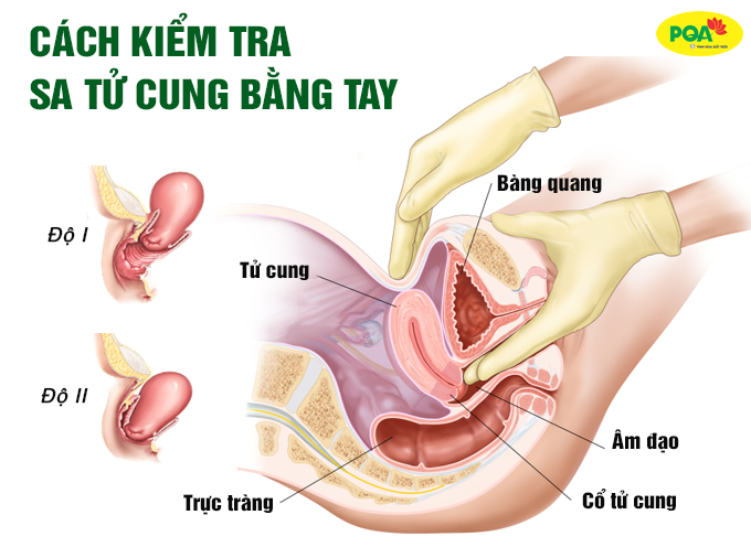 Hướng dẫn cách nhận biết sa tử cung bằng tay đơn giản tại nhà Hướng dẫn cách nhận biết sa tử cung bằng tay đơn giản tại nhà