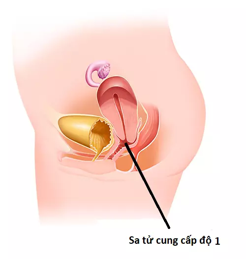 hình ảnh sa tử cung cấp độ 1