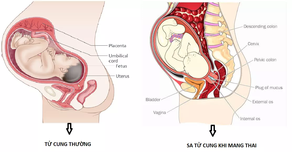 hình ảnh sa tử cung khi mang thai