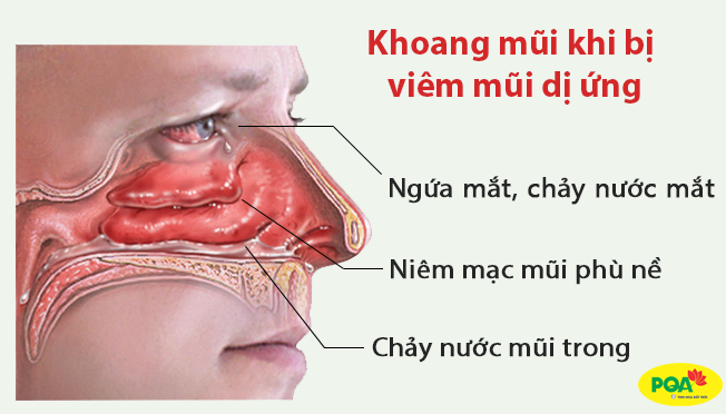 bệnh viêm mũi dị ứng