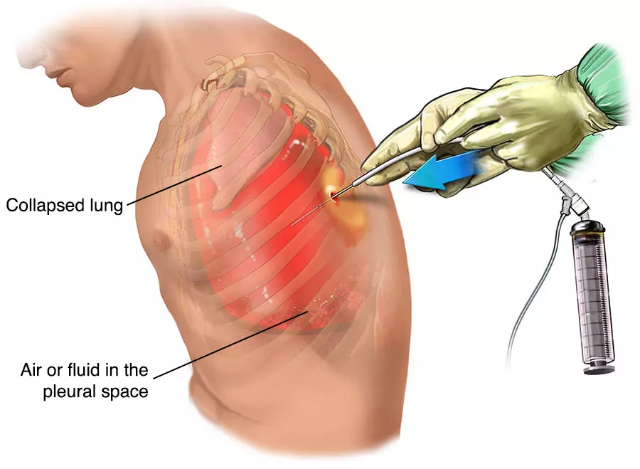 tràn khí màng phổi gây rách màng phổi