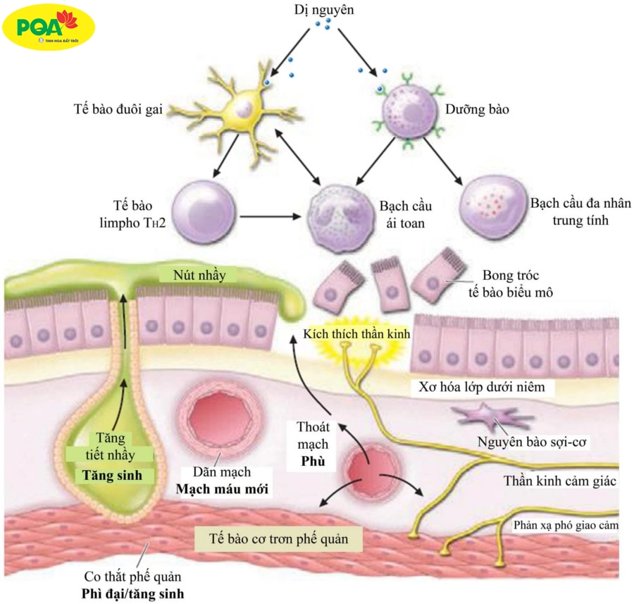 Tại sao hen phế quản khó thở thì thở ra? Giải đáp từ chuyên gia Tại sao hen phế quản khó thở thì thở ra? Giải đáp từ chuyên gia