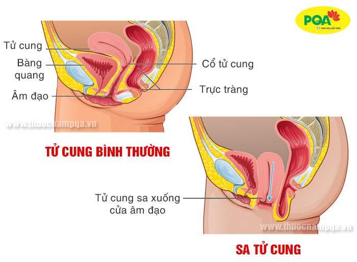 Cách hỗ trợ điều trị sa tử cung sau sinh hiệu quả