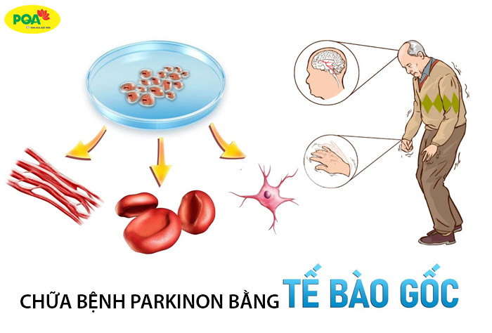 Điều trị Parkinson bằng tế bào gốc có hiệu quả không?