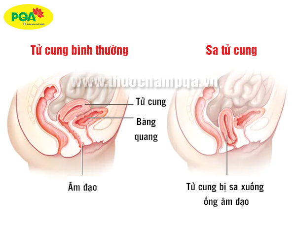 khám sa tử cung như thế nào?