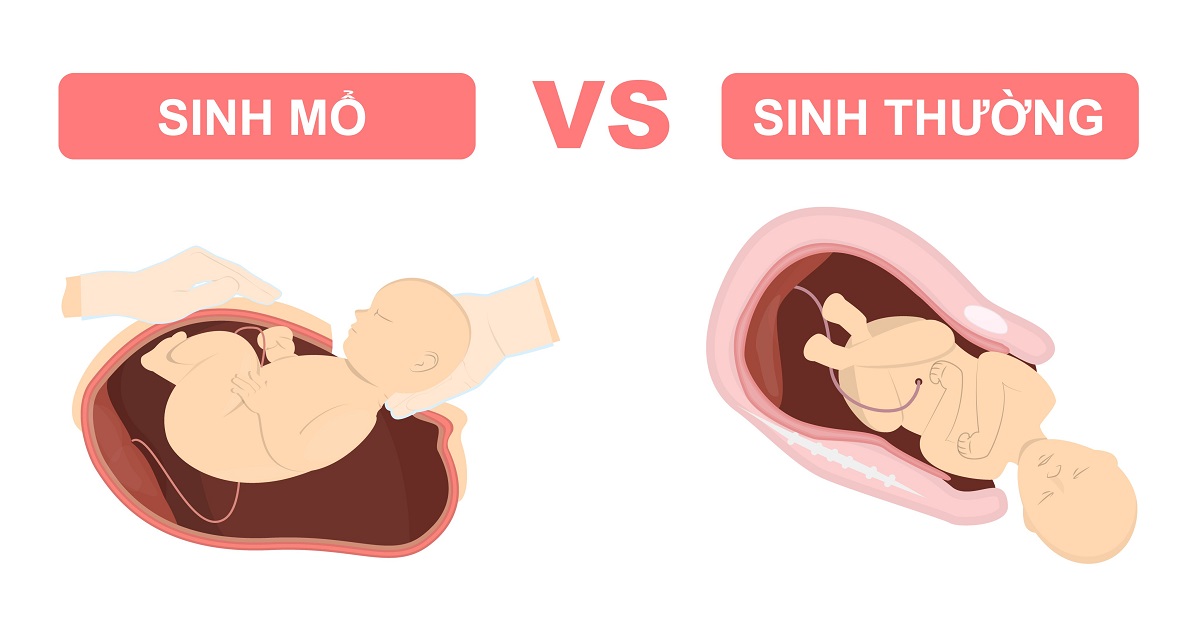 sinh thường có tỷ lệ mắc sa tử cung cao hơn