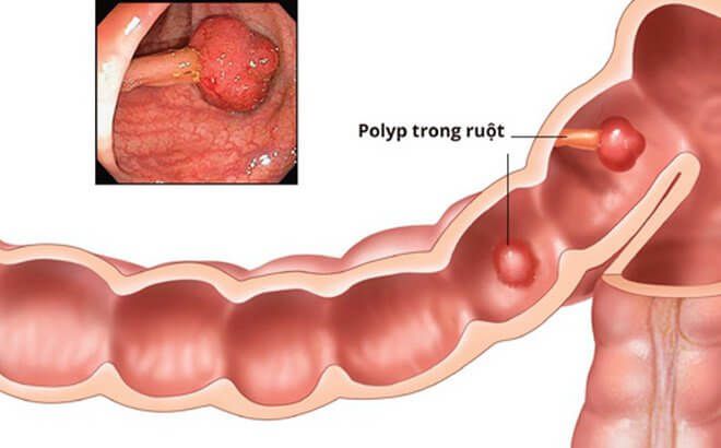 Táo bón đi ngoài ra máu gây polyp trong ruột