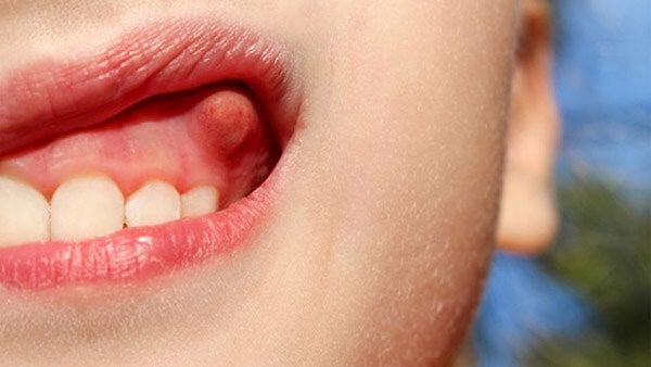 Áp xe chân răng có thể gây chảy máu chân răng