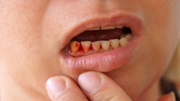 Vì sao trẻ bị chảy máu chân răng 