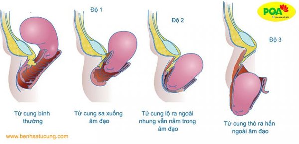 3 cấp độ của sa tử cung